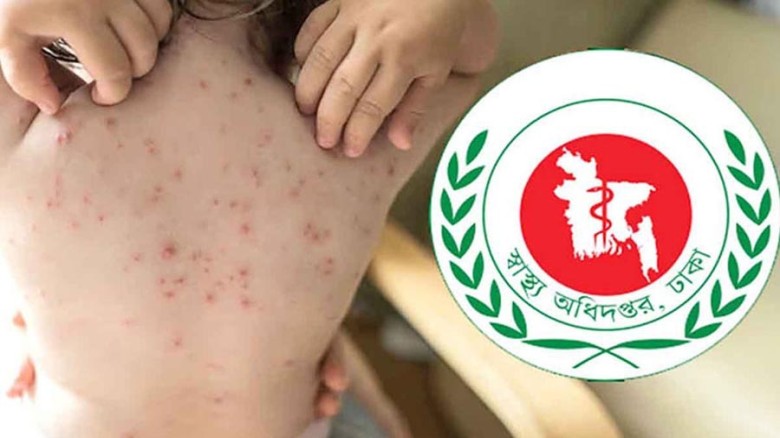 হামের উপসর্গে ২৪ ঘণ্টায় আরও ৭ শিশুর মৃত্যু, মোট ৯১৫